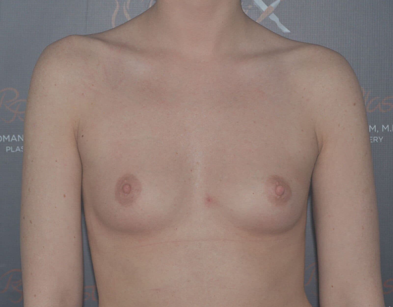 breast augmentation before