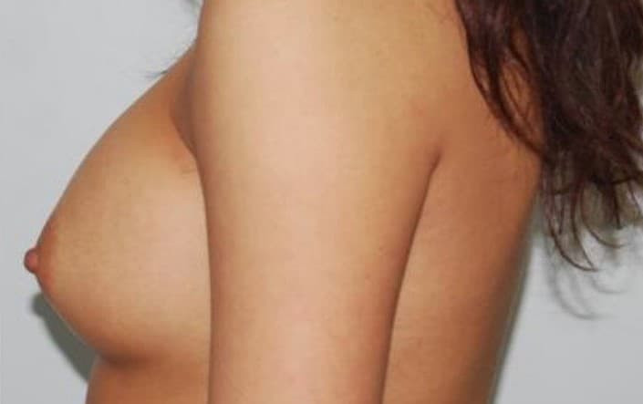 breast augmentation after