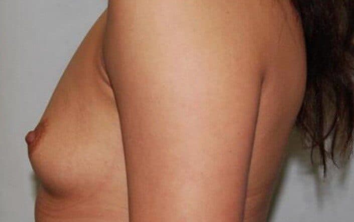 breast augmentation before