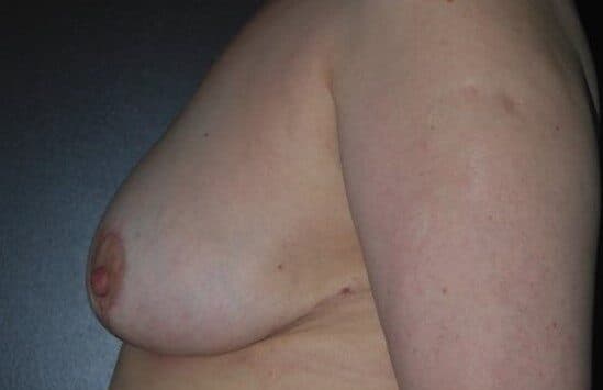 breast reduction after