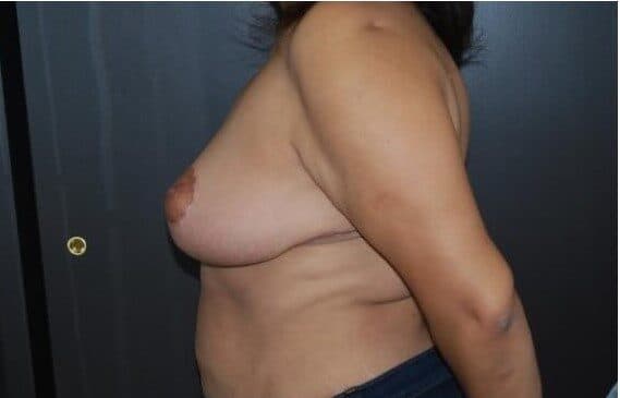 breast reduction after