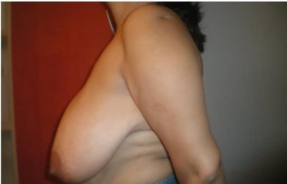 breast reduction before