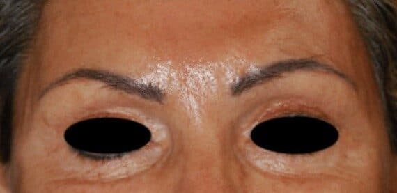 brow lift after