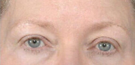 brow lift after