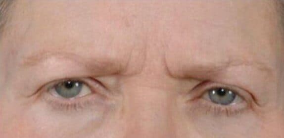 brow lift before