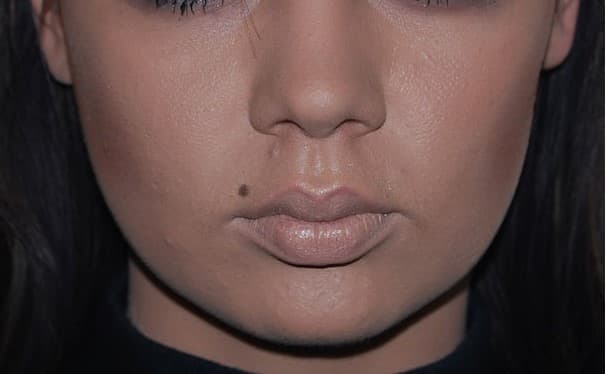 buccal fat removal after