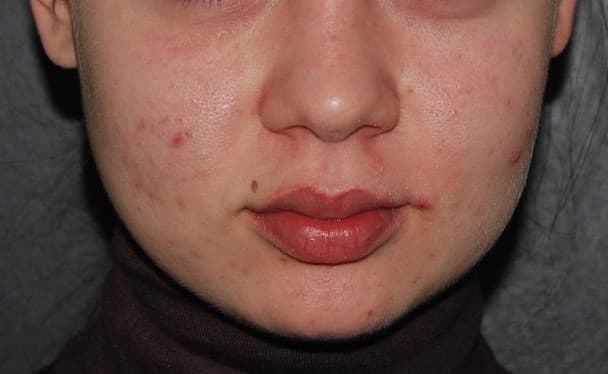 buccal fat removal before