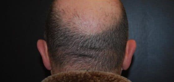 ear surgery before