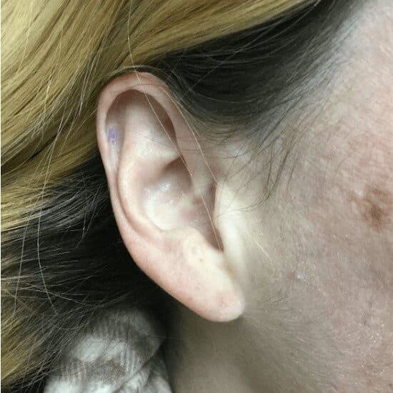 torn earlobe repair after