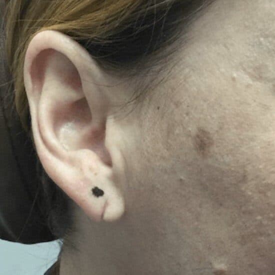 torn earlobe repair before
