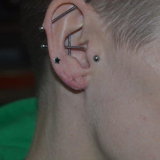 torn earlobe repair after