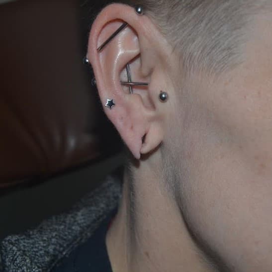 torn earlobe repair before
