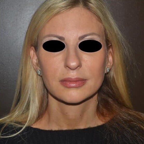 face lift after