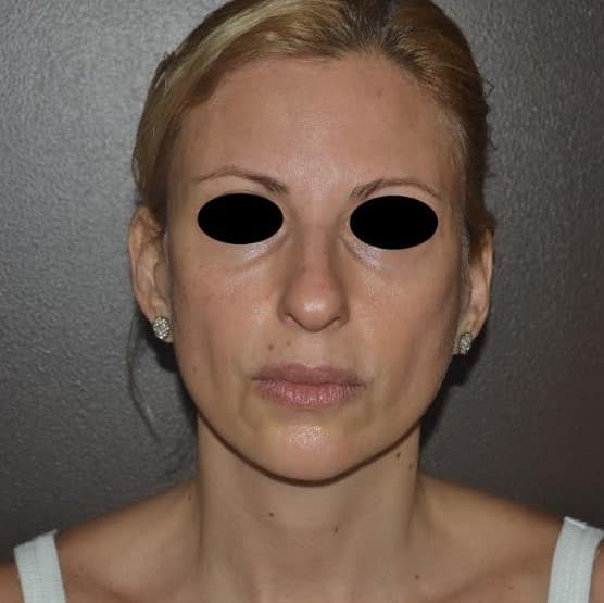 face lift before