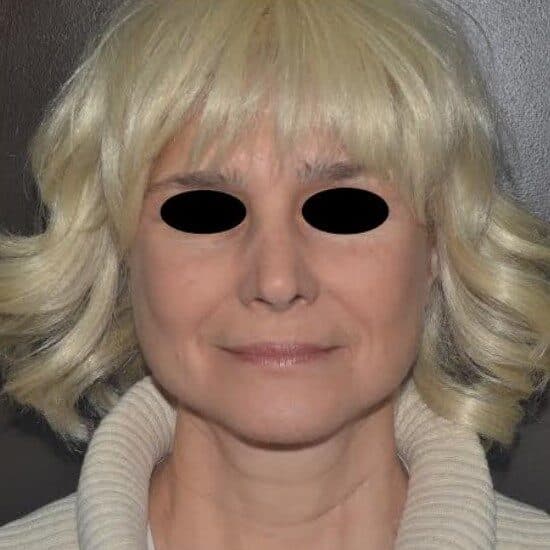 face lift after