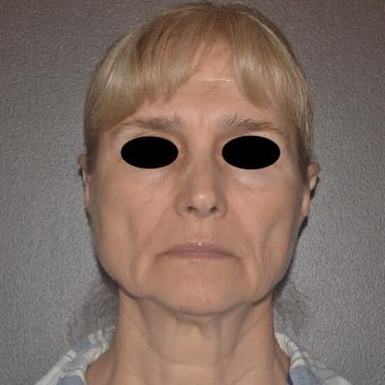 face lift before