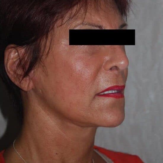 face lift after