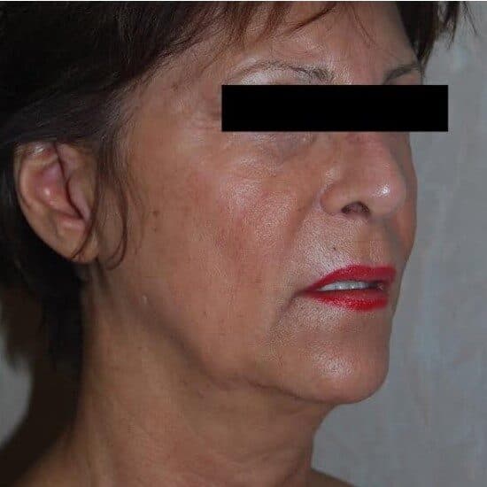 face lift before