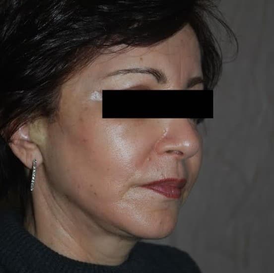 face lift after