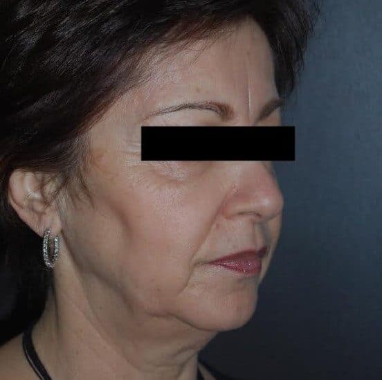 face lift before