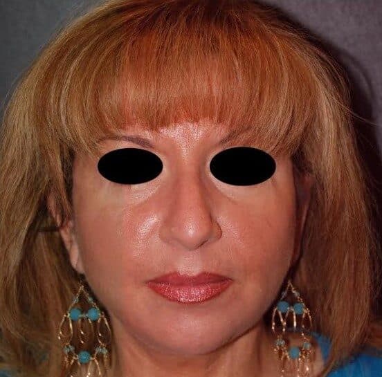 face lift after