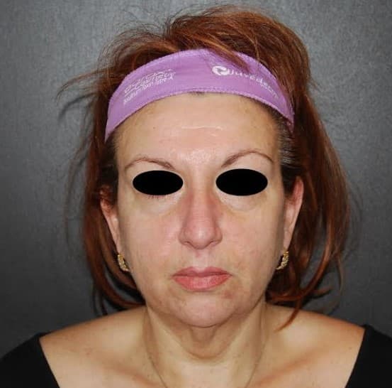face lift before