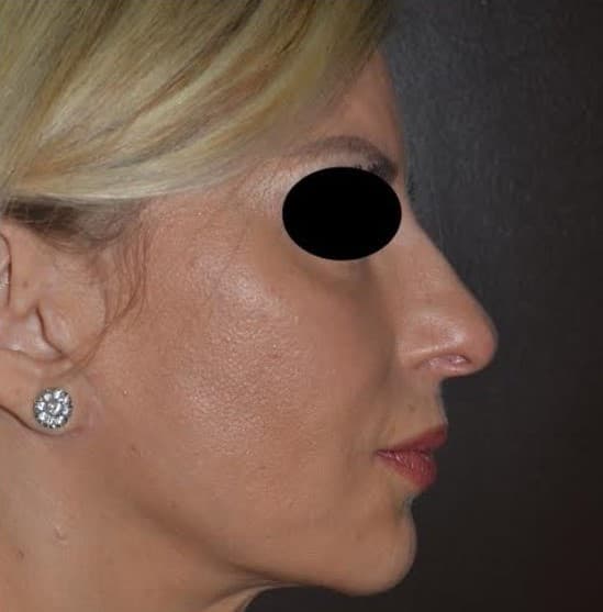 face lift after