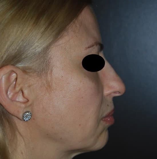face lift before