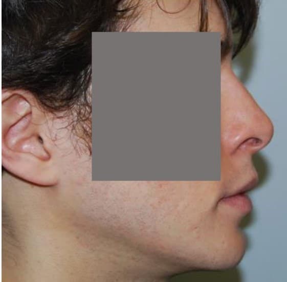 facial implants after