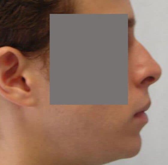 facial implants before