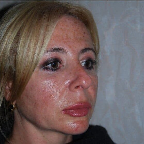 facial implants after