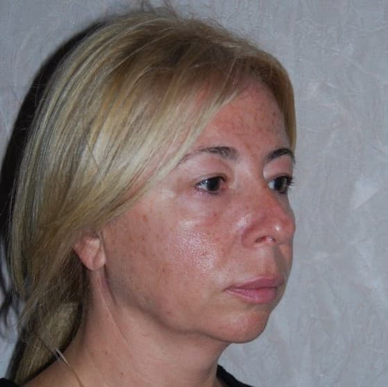facial implants before