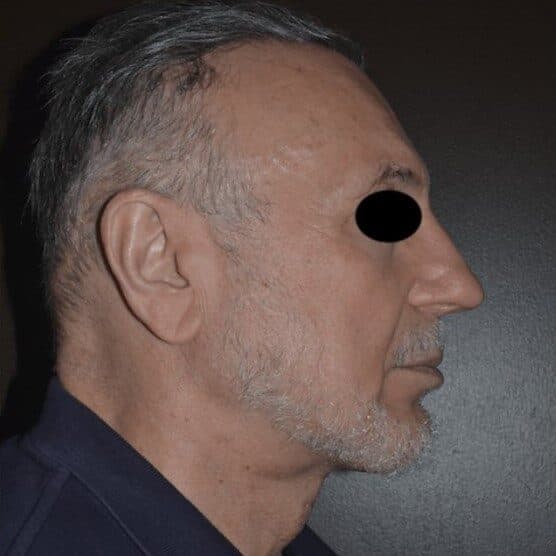 facial implants after