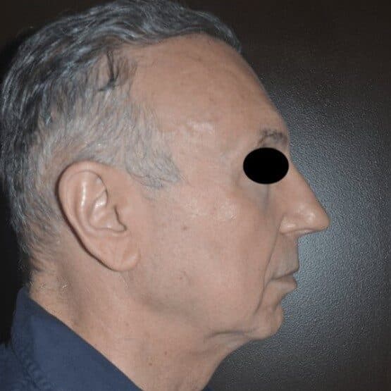 facial implants before