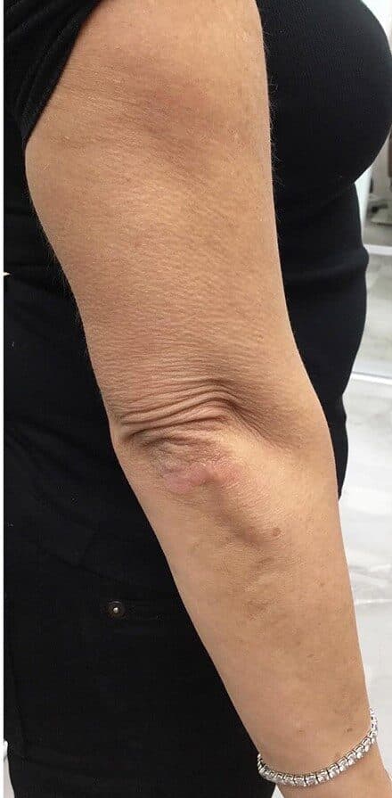 genius RF microneedling after