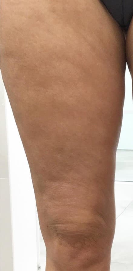 genius RF microneedling after