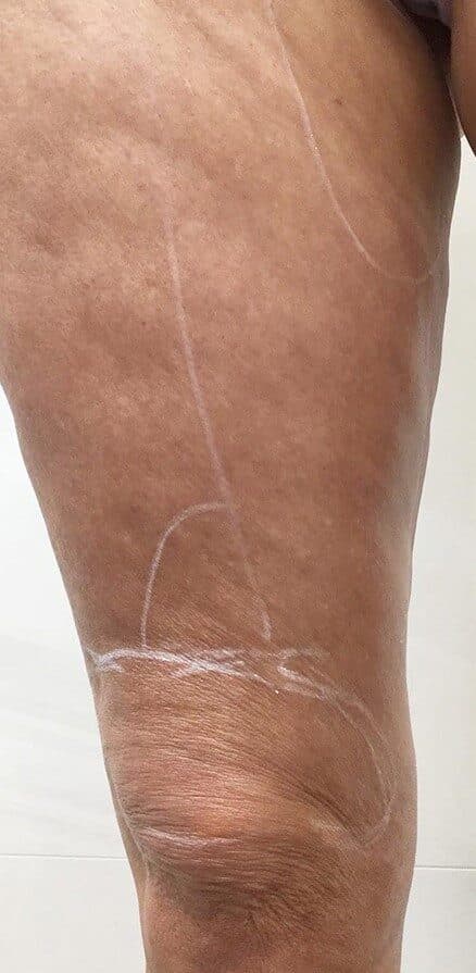 genius RF microneedling before