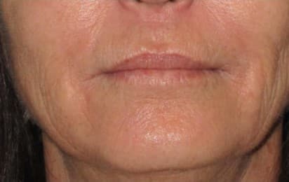 genius RF microneedling after