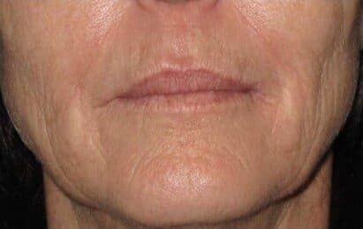 genius RF microneedling before