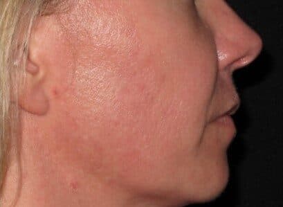 genius RF microneedling after