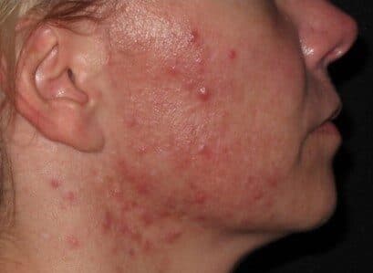 genius RF microneedling before