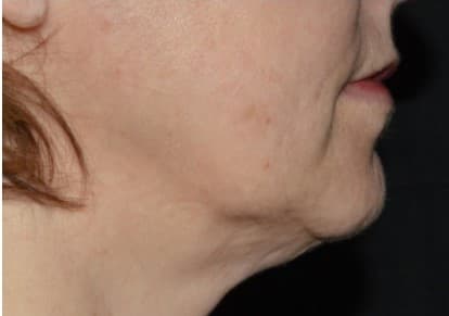 genius RF microneedling after