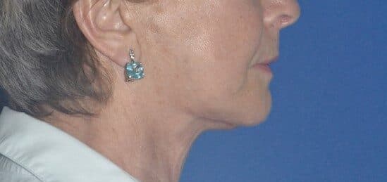 neck lift after