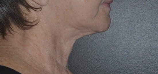 neck lift before
