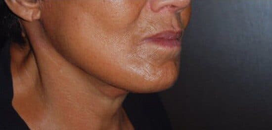 neck lift after