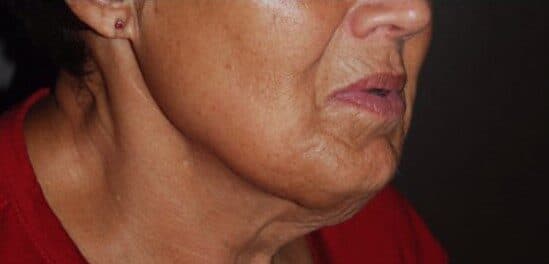 neck lift before