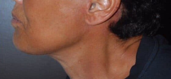 neck lift after