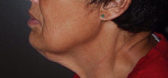 neck lift before