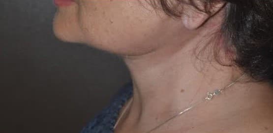 neck lift after