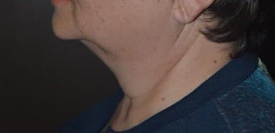 neck lift before